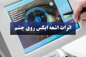 اثرات اشعه ایکس روی چشم