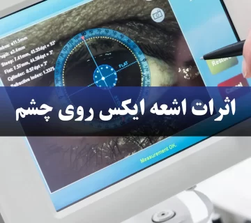 اثرات اشعه ایکس روی چشم